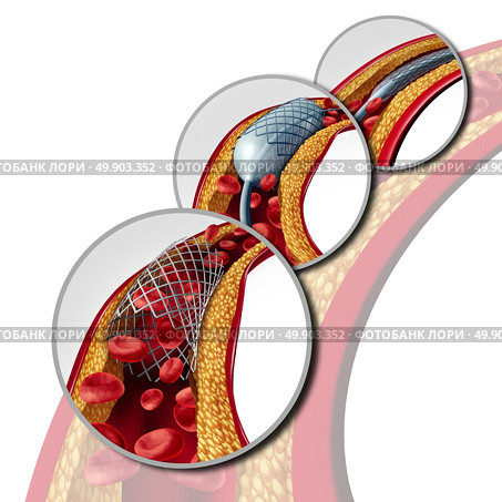 Angioplasty and stent concept as a heart disease treatment symbol diagram with the stages of an implant procedure in an artery that has cholesterol plaque blockage being opened for increased blood flow as a 3D illustration. Стоковое фото, агентство Ingram Publishing / Фотобанк Лори