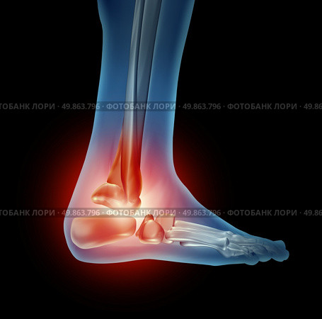 Ankle foot pain with a skeleton of the walking body part with bones in red where there is inflammation of the side view joint that has an orthopedic joint injury caused by bad shoes or running accident. Стоковое фото, агентство Ingram Publishing / Фотобанк Лори