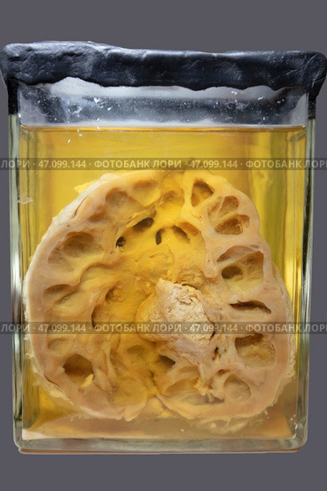 April 1, 2023. Belarus, Minsk. Exhibition of anatomical exhibits. A human kidney with a stone is an anatomical exhibit preserved in alcohol in a formaldehyde solution. Редакционное фото, фотограф Лазаренко Светлана / Фотобанк Лори
