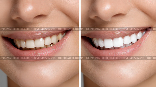 Before After Dental Whitening, Close-Up of Yellowish vs Bright White Smile Split. До и после отбеливания зубов, крупный план желтоватой и ярко-белой улыбки. Стоковое AI-изображение, AI-художник Katsiaryna Repich / Фотобанк Лори