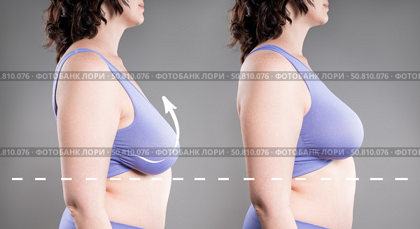 Before and after breast augmentation, woman with large saggy breasts, reduction mammoplasty, plastic surgery, aesthetic, healthcare and medicine concept. Стоковое фото, фотограф Станислав Тарко / Фотобанк Лори