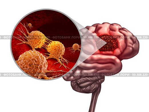 Brain cancer anatomy concept and malignant tumor or tumour symbol as a neurology body part with a microscopic magnification of malignant cells dividing and spreading with 3D illustration elements. Стоковое фото, агентство Ingram Publishing / Фотобанк Лори