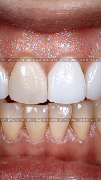Brightened Teeth After Whitening Treatment Showcasing Smooth Enamel and Uniform Color. Стоковое AI-изображение, AI-художник Юлия Гапеенко / Фотобанк Лори