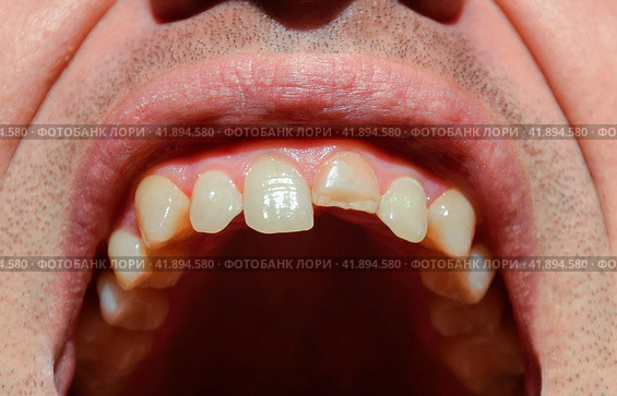 Broken tooth. Broken upper incisor in a man mouth. Стоковое фото, фотограф Леонид Еремейчук / Фотобанк Лори