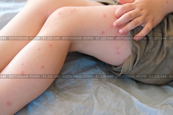 Child scratch body has sensitive itchy skin. Bodily rash. Kid allergy closeup. Little baby scratches eruption. Irritation, hive. Pruritus. Mosquito insect bite. Red from sunburn, Seborrheic Dermatitis. Стоковое фото, фотограф Марина Демидюк / Фотобанк Лори