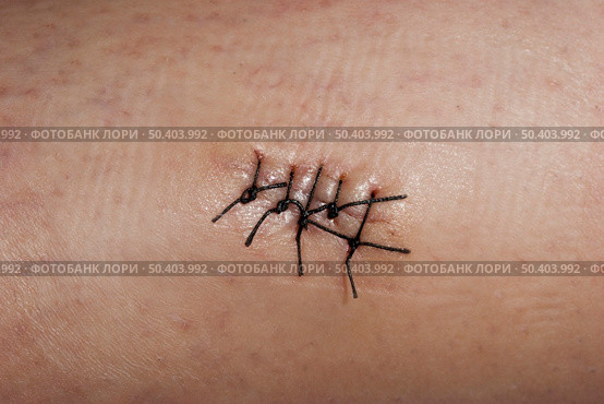 Close-up picture of a skin wound with stitches. Стоковое фото, агентство Ingram Publishing / Фотобанк Лори