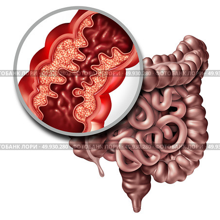 Crohna??s disease or crohn illness medical concept as a close up of a human intestine with inflammation symptoms causing obstruction as a 3D illustration. Стоковое фото, агентство Ingram Publishing / Фотобанк Лори