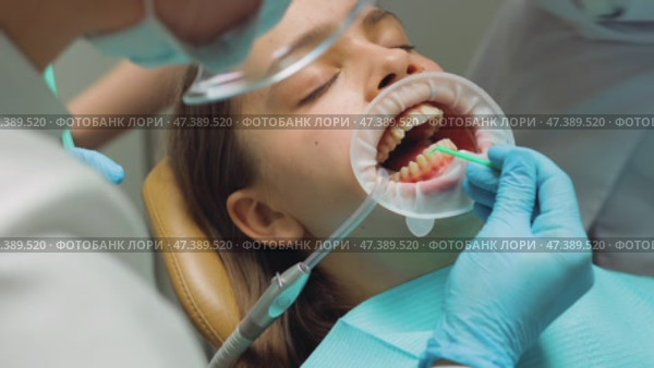Dentist applying adhesive to patients teeth before aligner placement during orthodontic procedure. Стоковое видео, видеограф Дмитрий Наумов / Фотобанк Лори