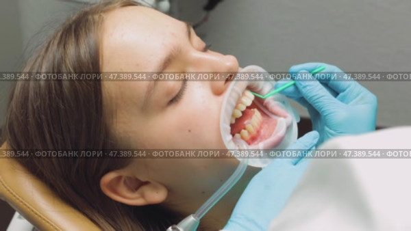 Dentist applying adhesive to patients teeth before aligner placement during orthodontic procedure. Стоковое видео, видеограф Дмитрий Наумов / Фотобанк Лори