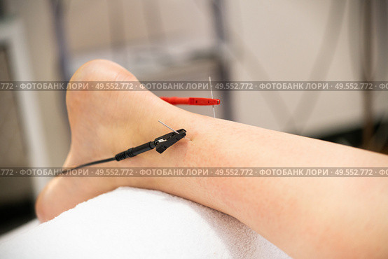 Electro-acupuncture dry with needle connecting machine. Electro stimulation in physical therapy.. Electro acupuncture dry with needle connecting machine. Стоковое фото, агентство Ingram Publishing / Фотобанк Лори