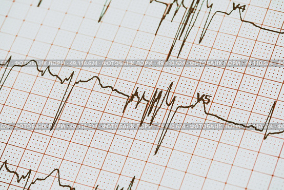 Extrasystoles On Electrocardiogram. Стоковое фото, агентство Ingram Publishing / Фотобанк Лори