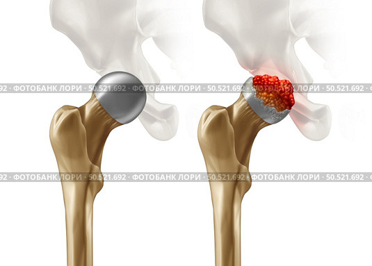 Femoral Head Disease and osteonecrosis or avascular necrosis and aseptic necrosis with a healthy hip compared to an osteoarthritis damaged pelvic joint in a 3D illustration style. Стоковое фото, агентство Ingram Publishing / Фотобанк Лори
