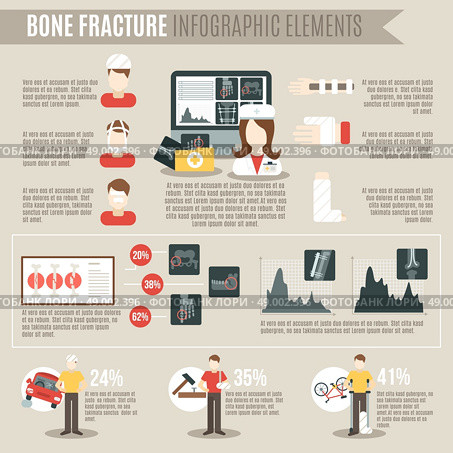 Fracture bone infographics set with medicine and physiology symbols and charts vector illustration. Fracture Bone Infographics. Стоковая иллюстрация, агентство Ingram Publishing / Фотобанк Лори