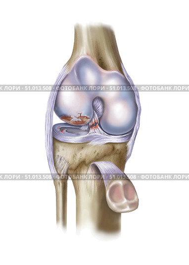 Front view of knee showing torn ACL and meniscus. Стоковое фото, фотограф Elise Walmsley-MacWha/Stocktrek Images / ТАСС / Фотобанк Лори