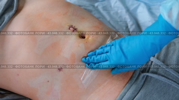 Hands of medic or nurse in blue gloves examining a fresh suture on a male stomach after laparoscopy surgical removal of appendicitis. Doctor examines of the patient. Man belly with medical stitches. Стоковое видео, видеограф Марина Демидюк / Фотобанк Лори