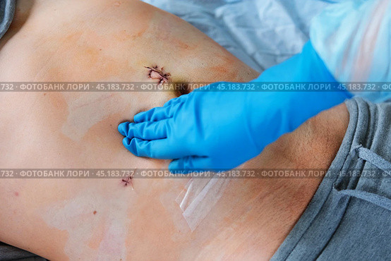 Hands of medic or nurse in blue gloves examining a fresh suture on a male stomach after laparoscopy surgical removal of appendicitis. Doctor examines of the patient. Man belly with medical stitches. Стоковое фото, фотограф Марина Демидюк / Фотобанк Лори