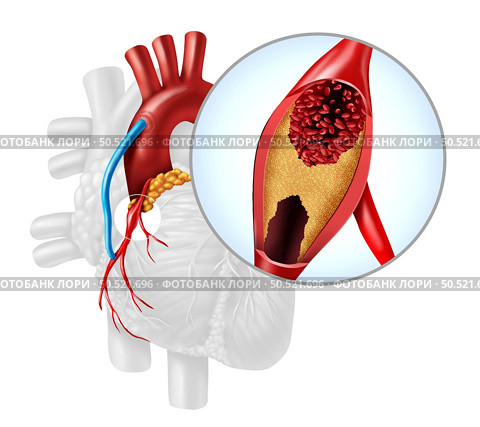 Heart Artery Bypass Grafting or CABG as an obstruction of plaque in the coronary artery or arteries as a vein from a leg that is grafted to a heart bypassing a blood circulation blockage in a 3D illustration style. Стоковое фото, агентство Ingram Publishing / Фотобанк Лори