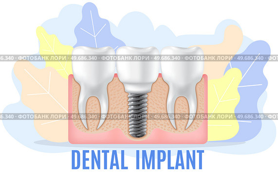 Human jaw with normal teeth and prosthesis above dental implant structure. Tooth after dental procedure. Surgical implant in oral cavity. Treatment, dentistry, oral care. Healthy tooth in human gum. Human jaw with normal healthy teeth and prosthesis in gum above structure of dental implant. Стоковая иллюстрация, агентство Ingram Publishing / Фотобанк Лори