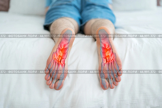 Joint diseases, hallux valgus, plantar fasciitis, man's leg hurts, foot pain. Стоковое фото, фотограф Станислав Тарко / Фотобанк Лори