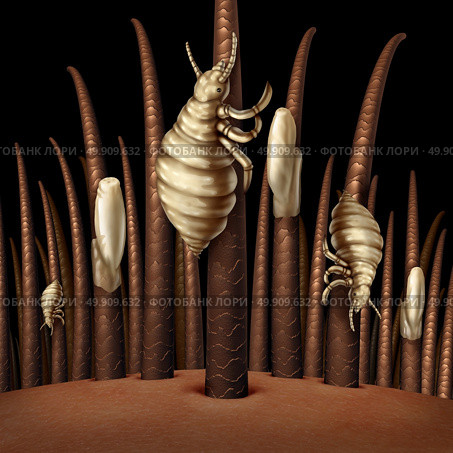 Lice on hair close up as a medical problem concept with a magnification of a human head with an infestation of parasitic nits or eggs hatching from a louse insect as a symbol of infection and treatment. Стоковое фото, агентство Ingram Publishing / Фотобанк Лори