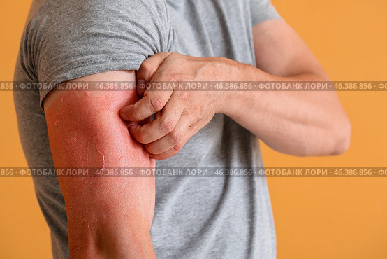 Man with red sunburned skin against color background, closeup. Стоковое фото, фотограф Pixel_shot / Фотобанк Лори