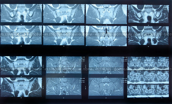 MRI sacroiliac articulation. Study of ankylosing spondyloarthritis patient. Стоковое фото, фотограф Леонид Еремейчук / Фотобанк Лори