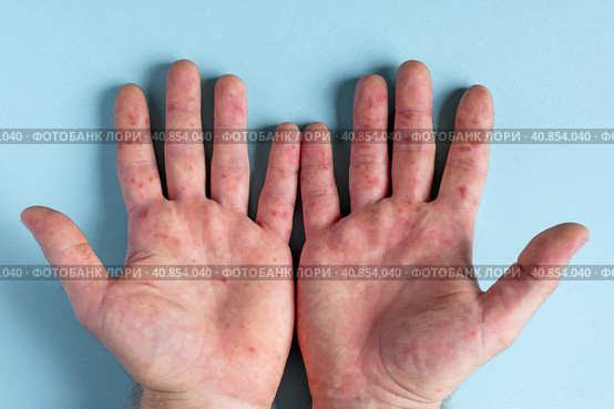 Painful rash, red spots blisters on the hand. Close up Allergy rash, human hands with dermatitis and Health problem. Ill eczema skin of patient. Viral Diseases. Red rashes on the palm. Enterovirus. Стоковое фото, фотограф Марина Демидюк / Фотобанк Лори