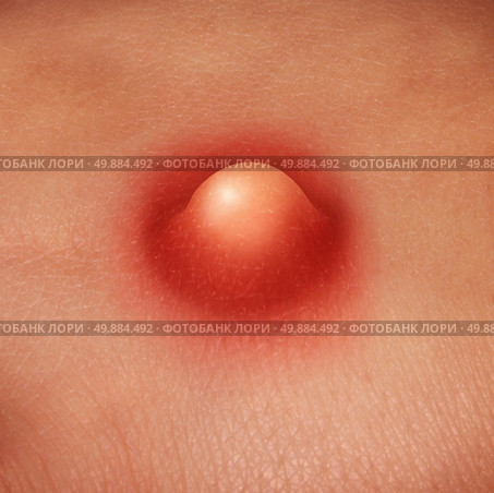 Pimple on human skin as a medical and dermatology health care concept with a blocked pore causing a whitehead red inflamation with bacterial or virus infection. Стоковое фото, агентство Ingram Publishing / Фотобанк Лори