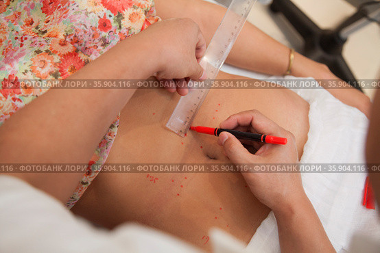 Plotting Points for Acupuncture Treatment. Стоковое фото, агентство Ingram Publishing / Фотобанк Лори