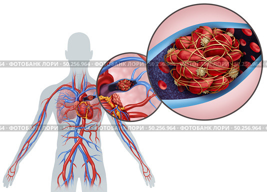 Pulmonary Embolism with a blood clot as a disease with a blockage of an artery in the lungs with 3D illustration elements. Стоковое фото, агентство Ingram Publishing / Фотобанк Лори