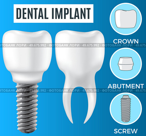 Realistic white dental implant and human tooth. Dentistry, medicine and oral cavity health concept. Denture construction, dental prosthesis structure. Information banner about teeth and implants. Realistic white dental implant and human tooth. Dentistry, medicine and oral cavity health. Стоковая иллюстрация, агентство Ingram Publishing / Фотобанк Лори