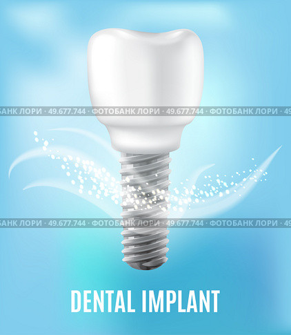 Realistic white dental implant and human tooth. Dentistry, medicine and oral cavity health concept. Denture construction, dental prosthesis structure. Information banner about teeth and implants. Realistic white dental implant and human tooth. Dentistry, medicine and oral cavity health. Стоковая иллюстрация, агентство Ingram Publishing / Фотобанк Лори