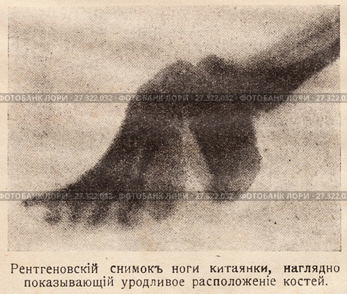 Рентгеновский снимок ноги китаянки, наглядно показывающий расположение костей. Иллюстрация из журнала "Природа и люди", 1915 год. Стоковая иллюстрация, иллюстратор Макаров Алексей / Фотобанк Лори