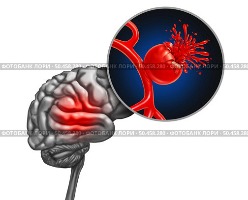 Ruptured brain Aneurysm as a medical concept with a bulging blood vessel as a ballooning artery with a rupture bleeding blood and causing a risk of hemorrhagic stroke as a 3D illustration. Стоковое фото, агентство Ingram Publishing / Фотобанк Лори