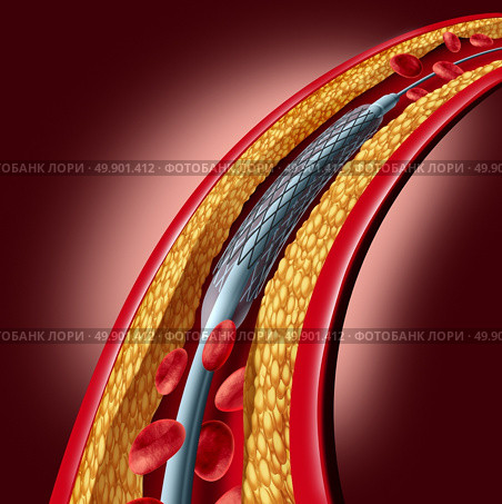 Stent coronary placement as an angioplasty medical implant concept as a heart disease treatment symbol with an implant in an artery that has cholesterol plaque blockage as a 3D illustration. Стоковое фото, агентство Ingram Publishing / Фотобанк Лори