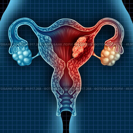 Uterus cancer and endometrial malignant tumor as a uterine medical concept as dangerous growing cells in a female body attacking the reproductive system as a symbol of cervical disease treatment diagnosis and symptoms with 3D illustration elements. Стоковое фото, агентство Ingram Publishing / Фотобанк Лори