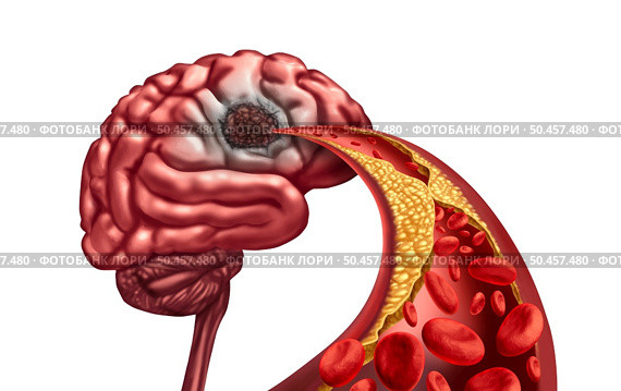 Vascular Dementia and Brain Liquefactive Necrosis due to loss of blood circulation to the mind after a stroke caused by artery blockage resulting in dead tissue damage and mental function with 3D render elements. Стоковое фото, агентство Ingram Publishing / Фотобанк Лори