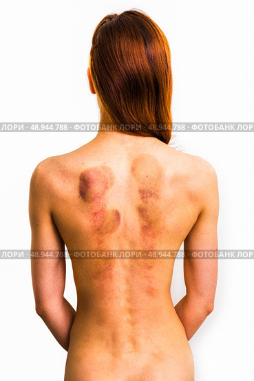 Young woman with marks from cupping therapy. Стоковое фото, агентство Ingram Publishing / Фотобанк Лори
